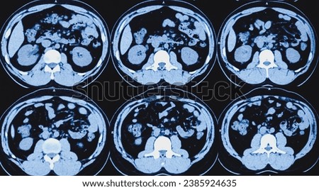 CT scan of KUB (non-contrast): Right lower ureteric calculus (at vesicoureteric junction) causing moderate hydroureteronephrosis of right kidney. Obstructive uropathy.