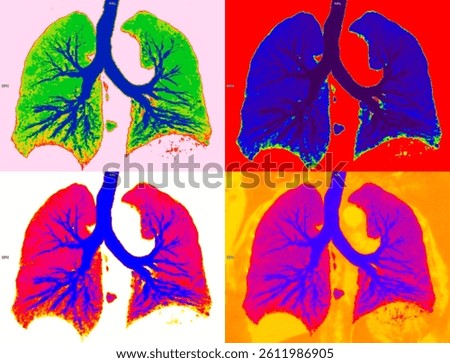 CT SCAN OF LUNGS WITH BRONCHIECTASIS IMAGE