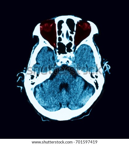 CT scan of  maxillary sinusitis