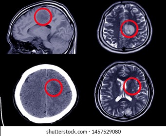 CT Scan and MRI of Brain a female 67year old history headache 2 monts showing Intracerebral Haemorrhage or mass on red mark ,Process tone color.