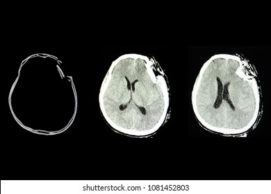 CT Scan Of A Patient With Traumatic Brain Injury Showing Depression Skull Fracture In The Frontotemporol Region With Edema.  Fractured Skull With Brain Injury. Accidental Trauma.  