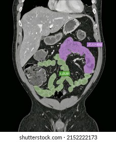 CT Scan: Radiographic Anatomy Of The Abdomen And Pelvis In Plane Coronal In Computed Tomography.