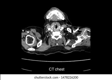 CT Scan Show CT Chest And CA Lung