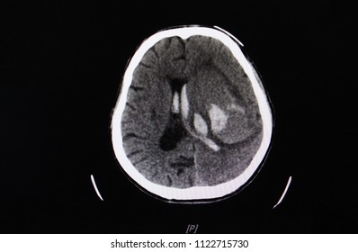 CT scan showing intracerebral hemorrhage.