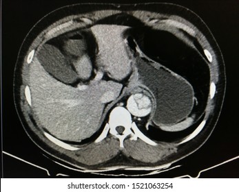 CT Scan Shows Aortic Dissection(suspected Stanford Type B) At Visualized Abdominal Aorta.