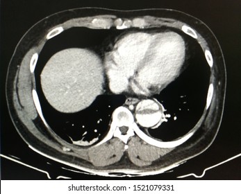 CT scan shows aortic dissection(suspected stanford type B) at visualized descending thoracic aorta and lower lung show mild fibosis at right lower lung base. 