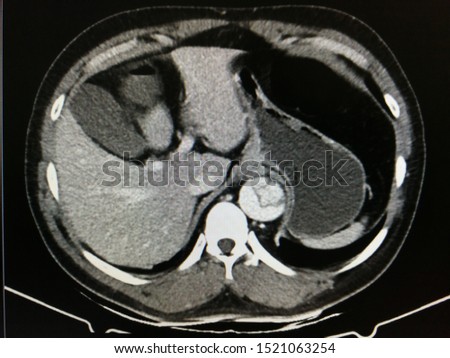 CT scan shows aortic dissection(suspected stanford type B) at visualized abdominal aorta.