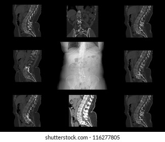 CT Scan Of Spine