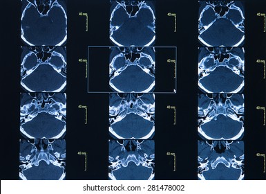 CT Scan Of Thoracic Segment. Science Background