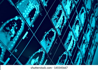 CT Scan Of Thoracic Segment. Scientific Background