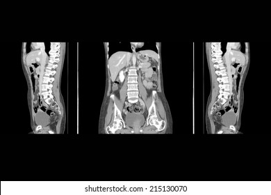 CT Scan Of Upper Abdomen