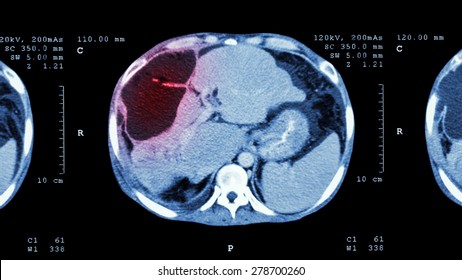 CT Scan Of Upper Abdomen : Show Abnormal Mass At Liver ( Liver Cancer ) 