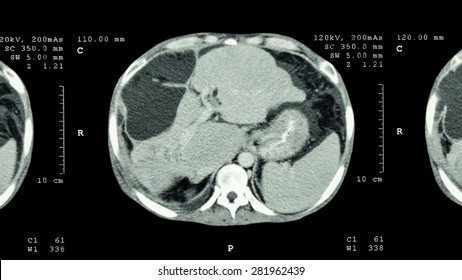 CT Scan Of Upper Abdomen : Show Abnormal Mass At Liver ( Liver Cancer ) 