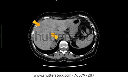 CT scan of upper abdomen : show abnormal mass at liver ( Liver cancer ).