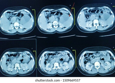 CT Scan Upper Abdomen A Woman 35 Year Old Impression: Mass At Pancreatic Tail ,diagnosis Pancreas,lymphoma Medical Healthcare And Technology Concept.