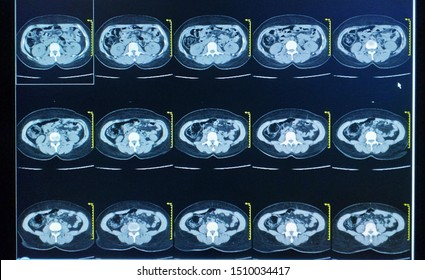 CT Scan Upper Abdomen A Woman 35 Year Old Impression: Mass At Pancreatic Tail ,diagnosis Pancreas,lymphoma Medical Healthcare And Technology Concept.