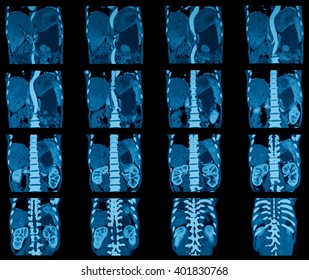 CT Scan Of Whole Abdomen, Abdominal Pain 