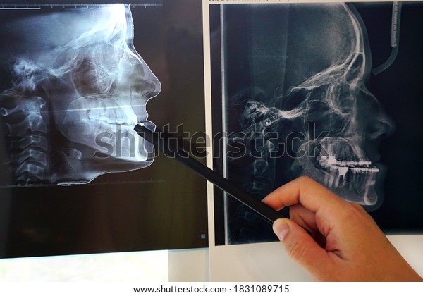 CT scans of\
teeth before and after orthodontic treatment. preparation for\
maxillofacial surgery. High quality\
photo
