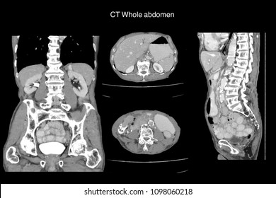 CT Whole Abdomen