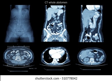 CT Whole Abdomen