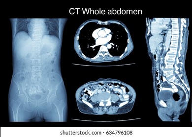 571 Pelvis ct scan Images, Stock Photos & Vectors | Shutterstock