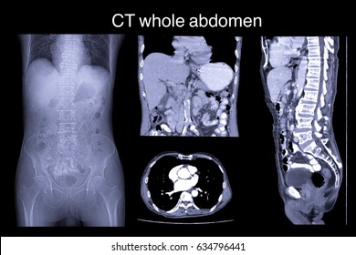 CT Whole Abdomen