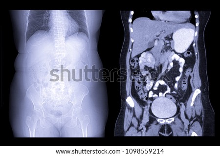 CT whole abdomen