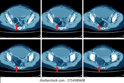 CT Whole Abdomen  Finding Fatty Mass With Calcification At Rt Adnexa, Representing Dermoid Cyst .The Mass Lesion Mass Effect To Rt Side Of Rectum.