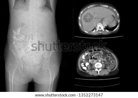 CT whole abdomen show hepatocarcinoma