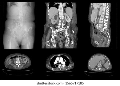 CT whole abdomen show hydronephrosis and urostoma - Shutterstock ID 1565717185