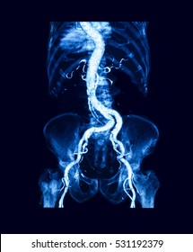 CTA (Computed Tomography Angiography) Of Abdominal Aorta, Posteroanterior View 