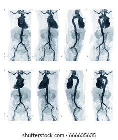 CTA (computed Tomography Angiography Or CT Angiography) Of Whole Abdominal And Pelvic Aorta (soft Tissue Technique) 