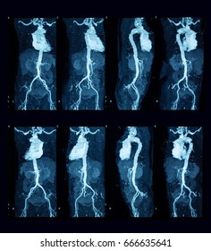 CTA (computed Tomography Angiography Or CT Angiography) Of Whole Abdominal And Pelvic Aorta (soft Tissue Technique) 