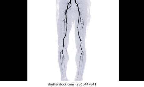 CTA femoral artery run off showing  femoral artery for diagnostic  Acute or Chronic Peripheral Arterial Disease.