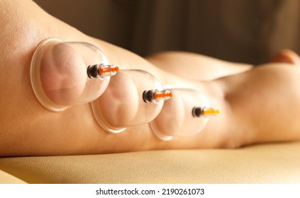 Cupping Therapy. Cup Vacuum Hip Massage. Close-up Of Young Woman's Anti-cellulite Procedure. The Concept Of Beauty And A Healthy Body. Tools For Smooth Skin.