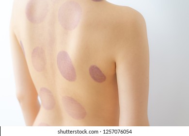 Cupping Therapy Marks On Skin