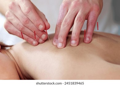 Cupping therapy with needle acupuncture for dry massage treatment - Powered by Shutterstock