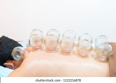 Closeup Cupping Treatment On Patient Back Stock Photo (Edit Now) 1513574558