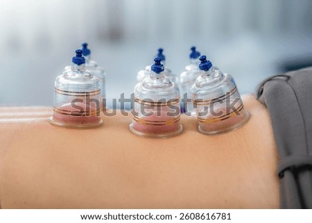 Cupping therapy on the back is performed in a physical therapy session for a woman. The clear suction cups are applied to the skin to promote blood flow and alleviate muscle tightness, 