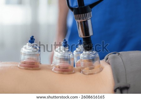 Cupping therapy on the back promotes circulation in a physical therapy session for a woman. The clear suction cups create a vacuum effect on the skin, targeting muscle tightness relief, 