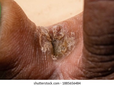 Curing, clear chronic interdigital athlete's foot between middle toe and ring toe of a right foot of early thirties male. Dead layers of the skin and erosions are visible due to long infection
