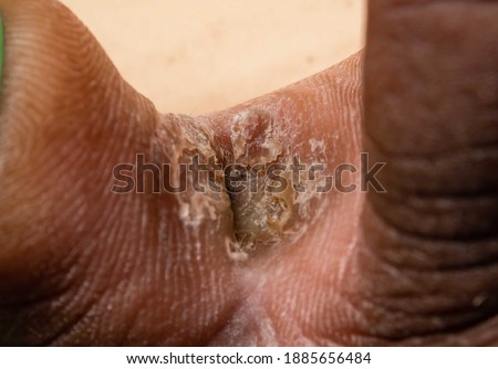 Curing, clear chronic interdigital athlete's foot between middle toe and ring toe of a right foot of early thirties male. Dead layers of the skin and erosions are visible due to long infection