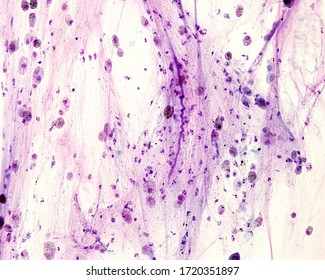 Curschmann's Spirals Are A Microscopic Finding In The Sputum Smears Of Asthmatics. They Are Spiral-shaped Mucus Plugs Formed In The Lower Airways When There Is Chronic Airway Obstruction.