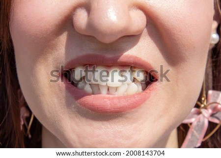 Curved female teeth, before installing braces. Close - up of teeth before treatment by an orthodontist