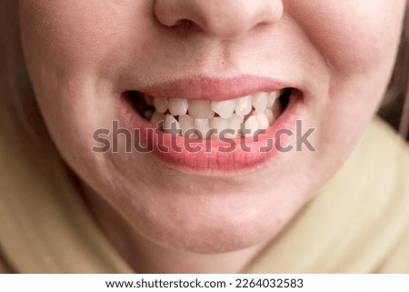 Curved female teeth, before installing braces. Close - up of teeth before treatment by an orthodontist.