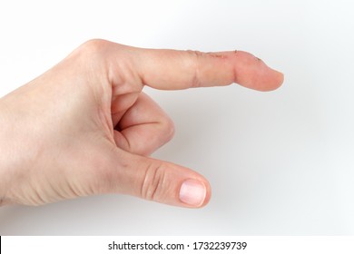 cut index finger with a extensor tendon injury, mallet finger, tip of the finger bending downwards while the rest of the finger stay straight, deformity in the last phalangeal bone, pointing direction