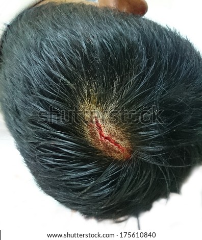 scalp laceration