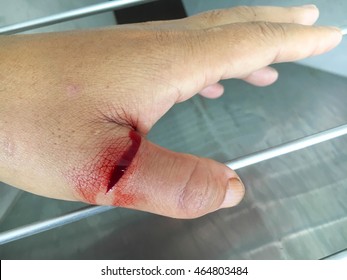 cut wound with blood on male finger
