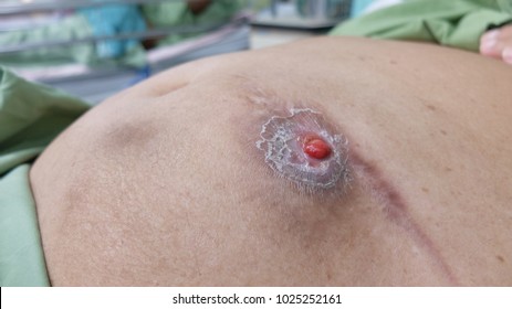 fistula enterocutaneous pengertian penyebab cutaneous mengenal penyakit