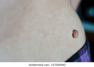 Cutaneous Skin Tag, Tumor At Woman Hip